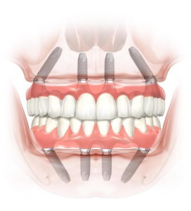 All-On-4® Dental Implant Alternative