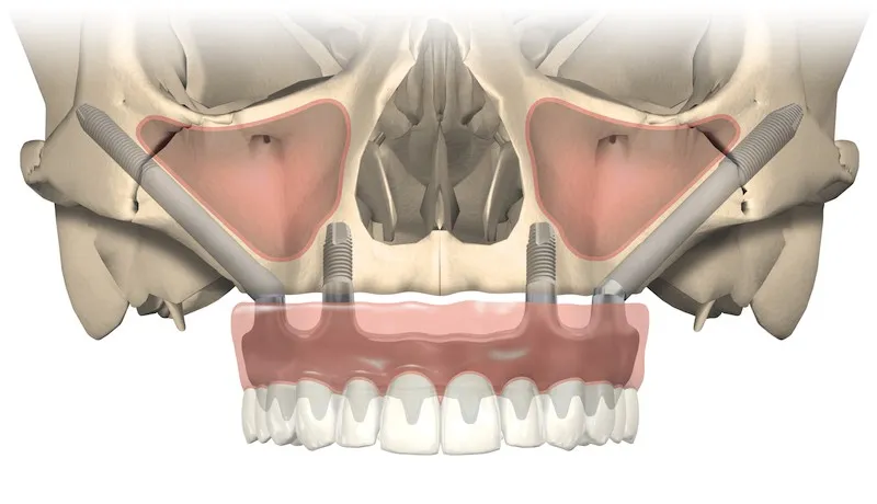 Zygomatic Implants in skull