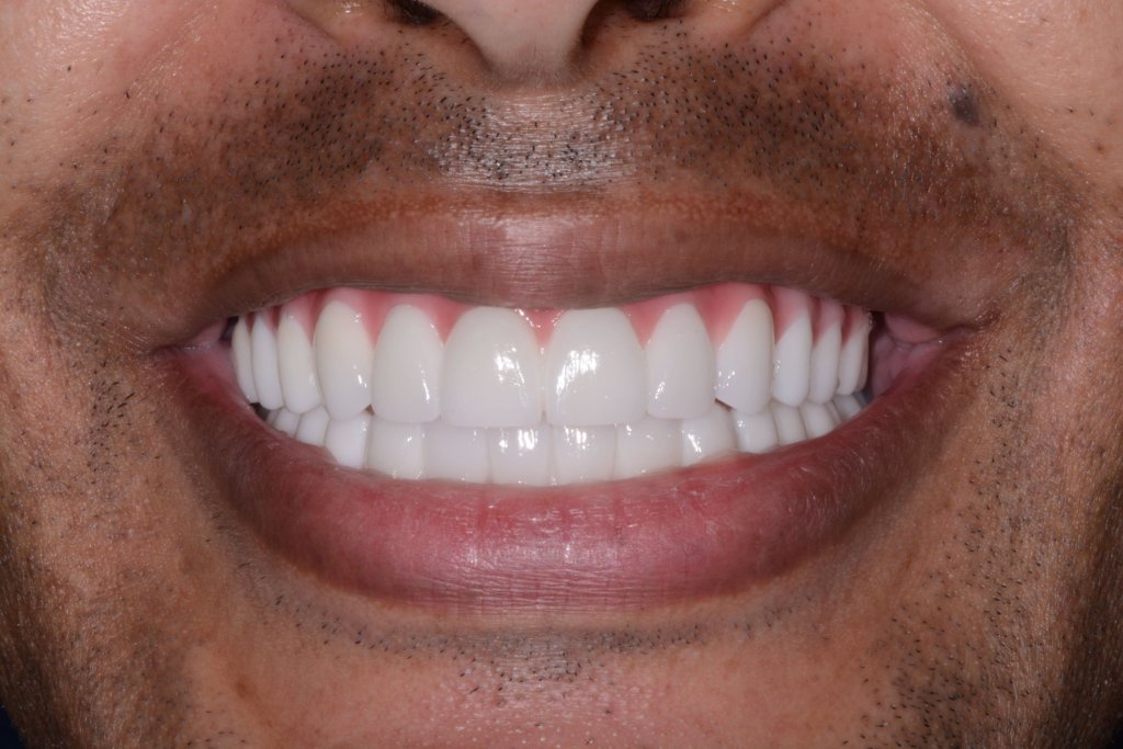 a smile After all-on-4 Dental Implants in rockford, il