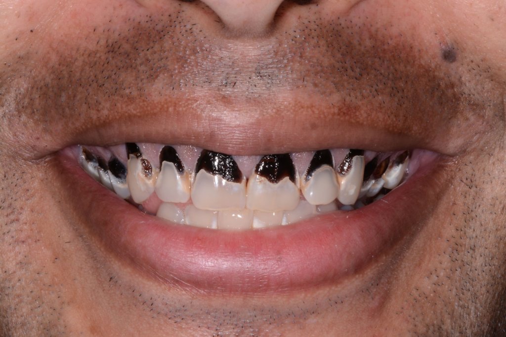 a smile Before all-on-4 Dental Implants done by rockfordoms