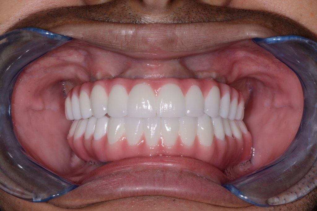 a smile After full mouth dental Dental Implants done in rockford, il