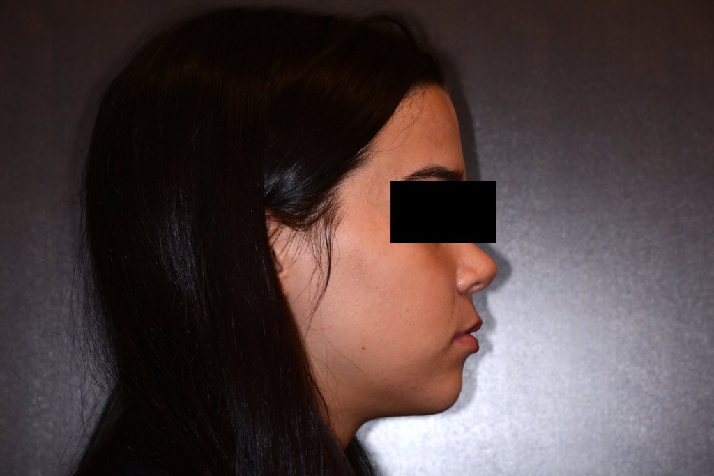 Girl's side profile after corrective jaw surgery