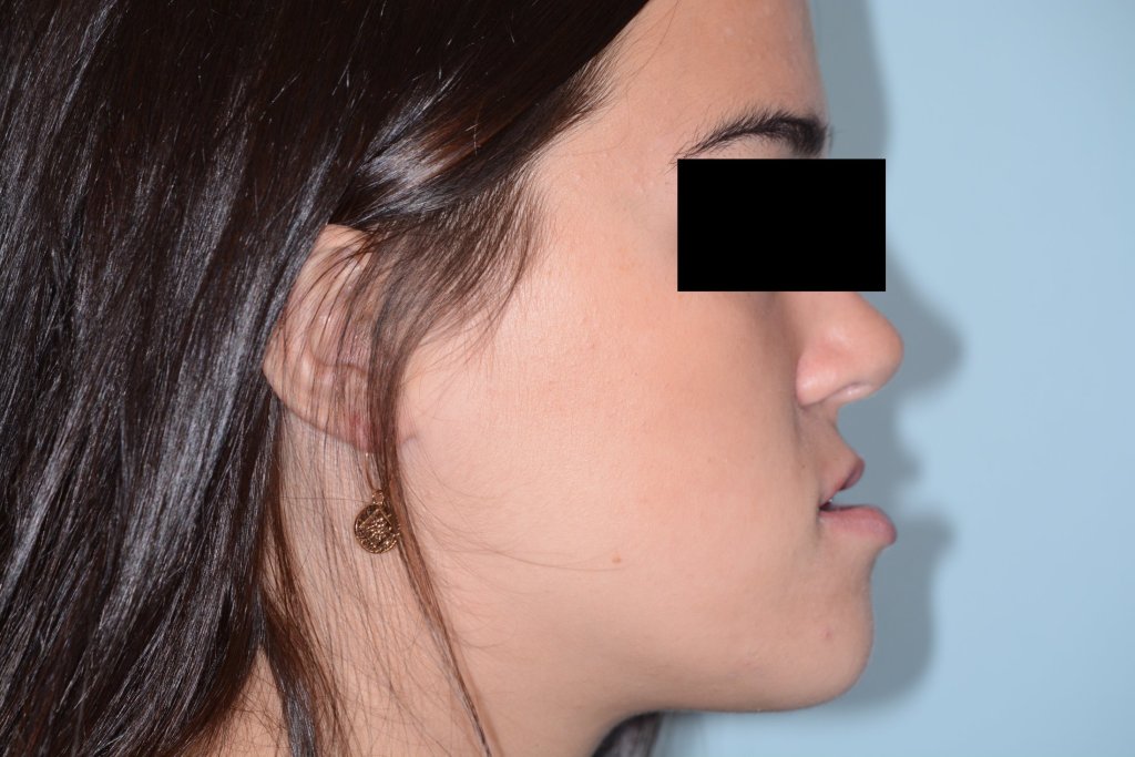 Girl's side profile before corrective jaw surgery