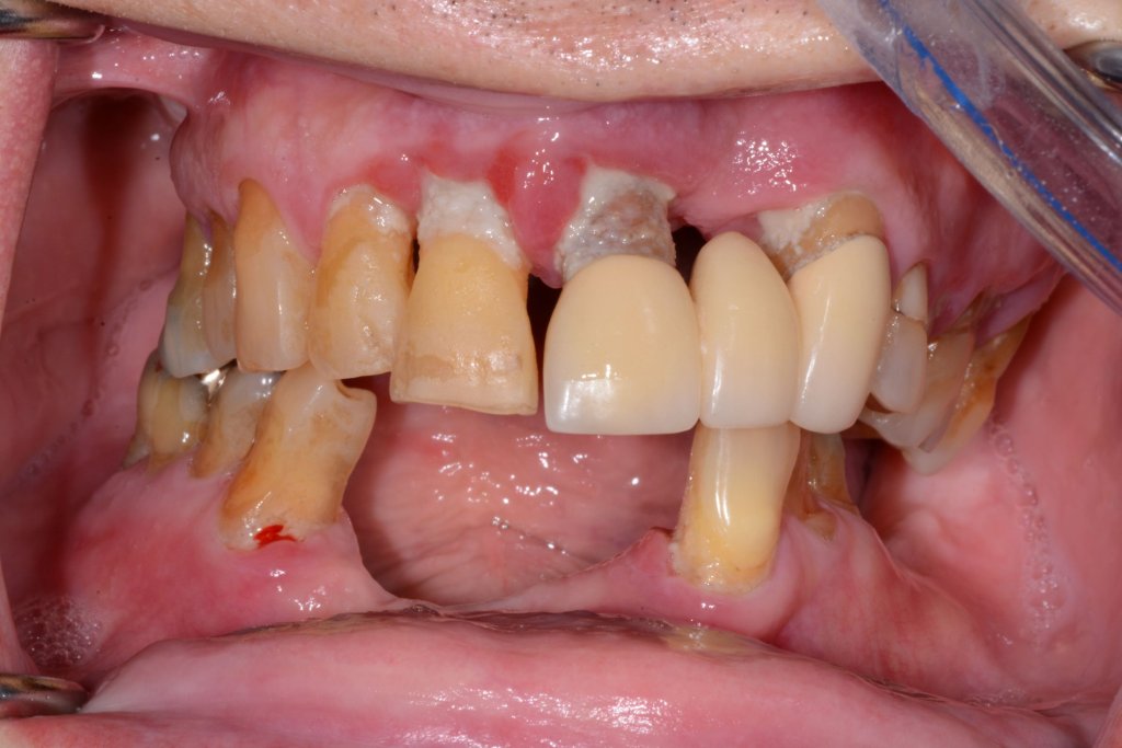 a smile Before Dental Implants