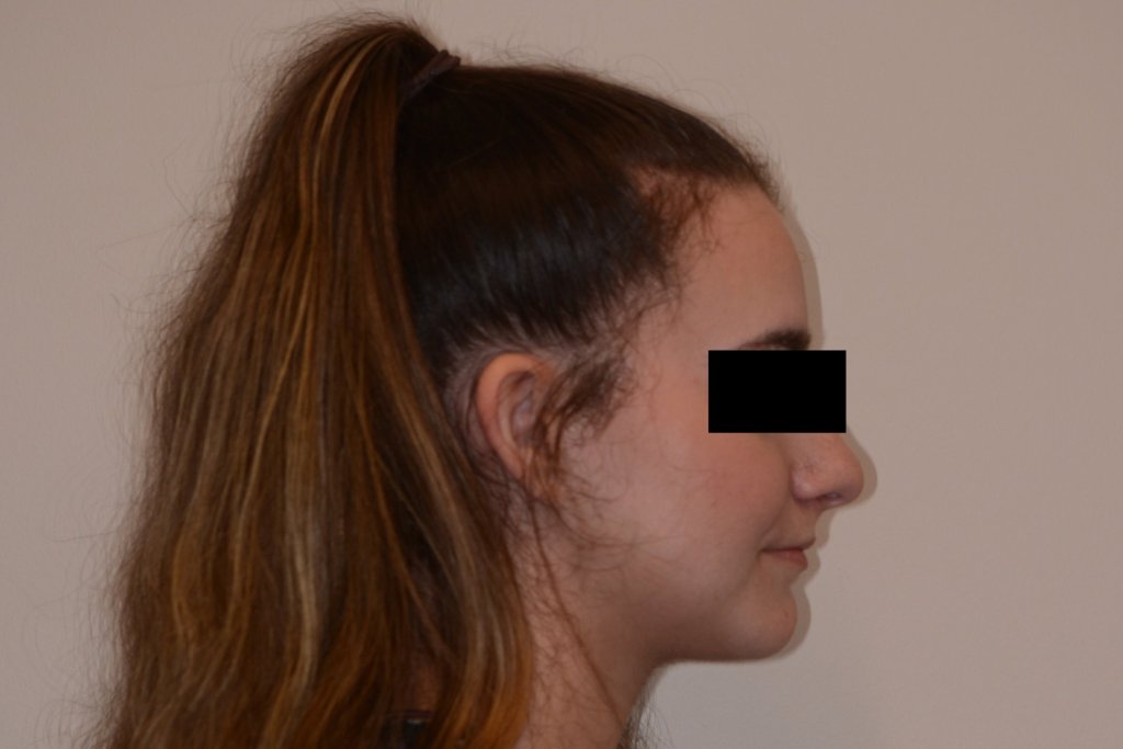 girl's side profile after jaw surgery