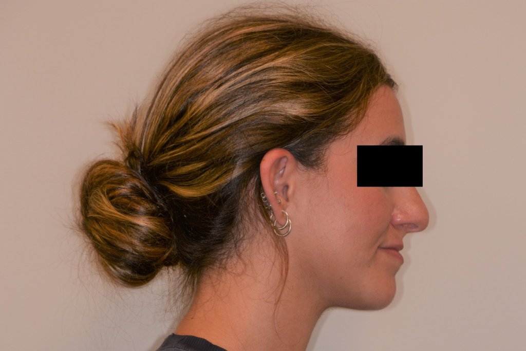 girl's side profile before jaw surgery