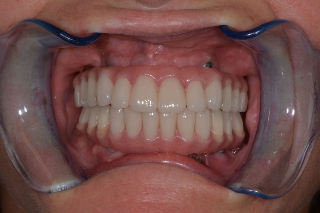 a smile After Dental Implants surgery in rockford, il